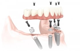 Dental Implants Nova Scotia